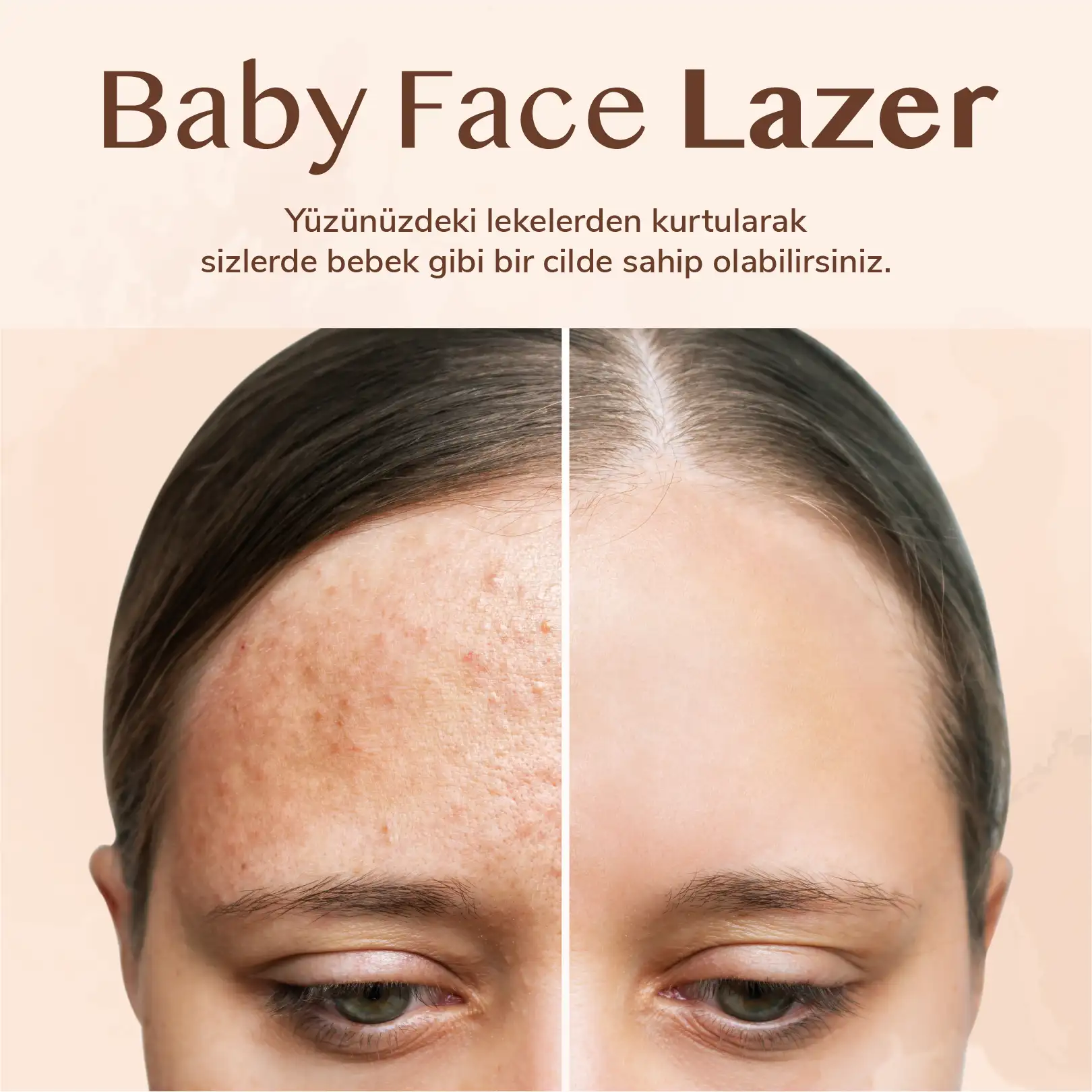 Baby Face Lazer | Dr. Lida Çiteli