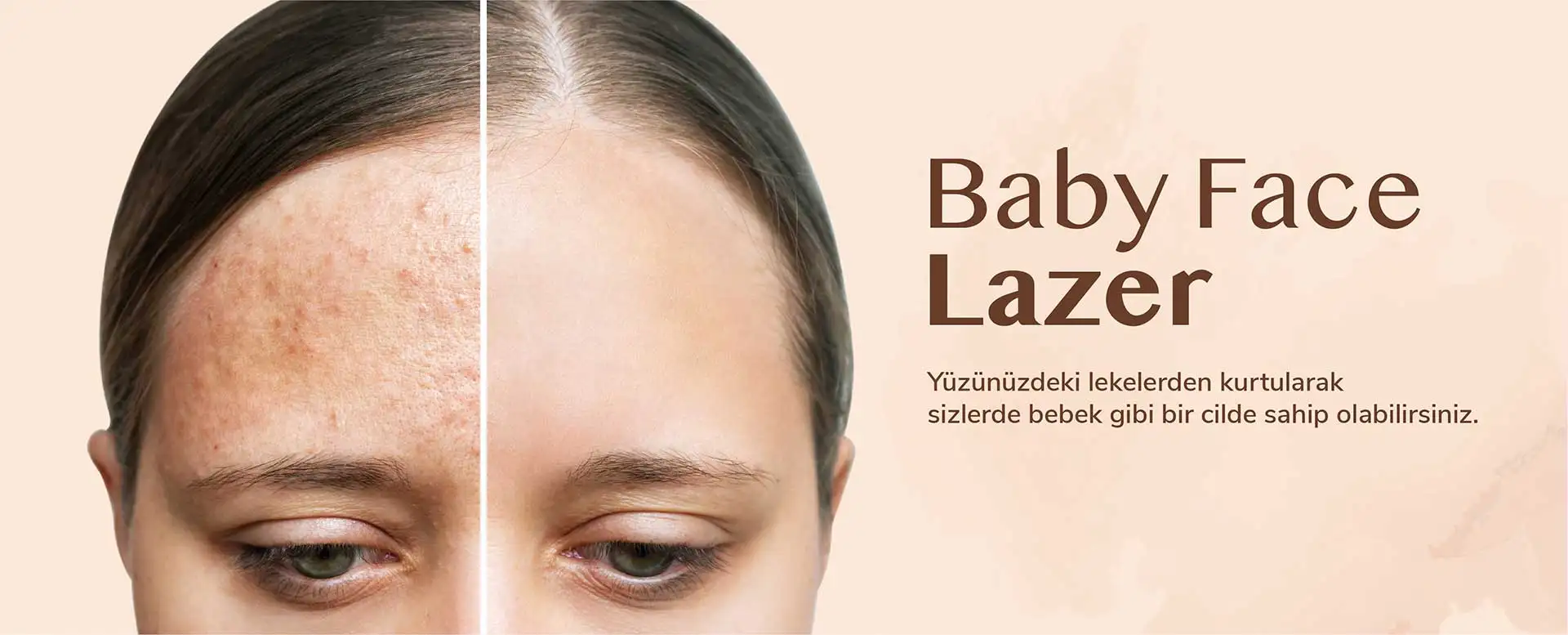 Baby Face Lazer | Dr. Lida Çiteli