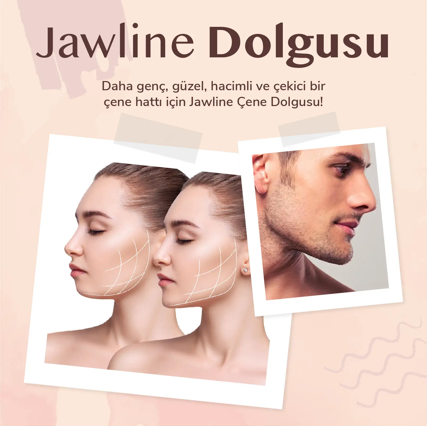 Jawline Dolgusu | Dr. Lida Çiteli